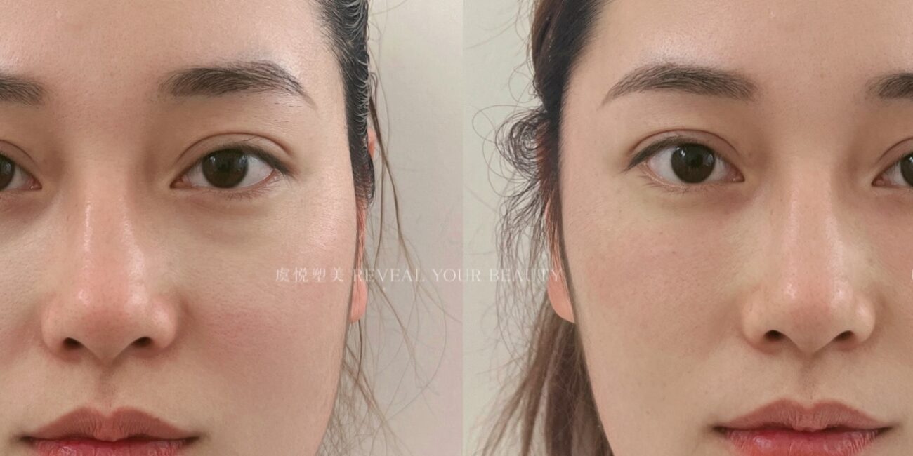 facial augmentation 01