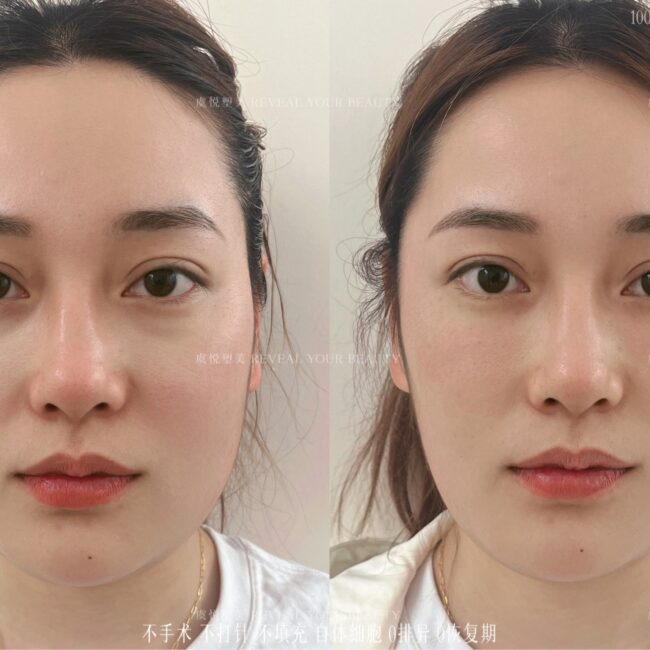 facial augmentation 01