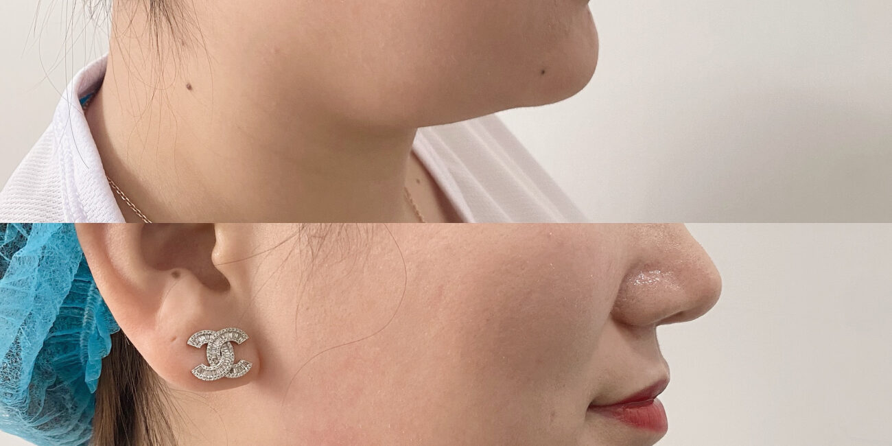 Face Slimming 01
