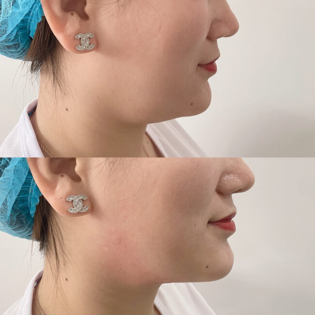 Face Slimming 01